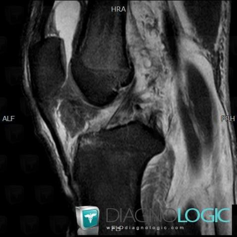 Posterior cruciate ligament rupture, Posterior cruciate ligament, MRI