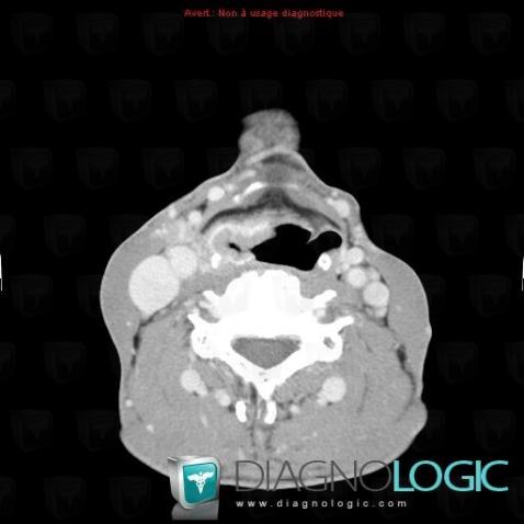 Posterolateral wall carcinoma, Pharyngolarynx, CT