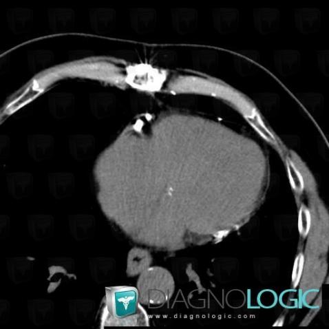 Postoperative, Cardiac cavities / Pericardium, CT