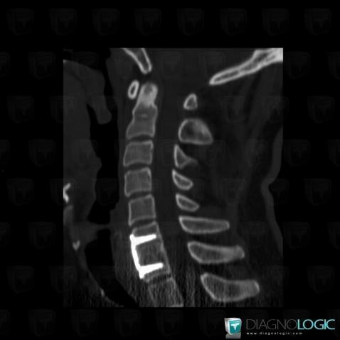 Postoperative, Vertebral body / Disk, CT