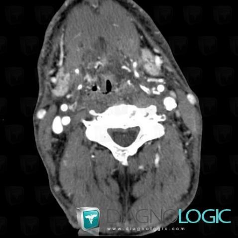 Postradiation edema, Oropharynx / Floor-mouth, CT