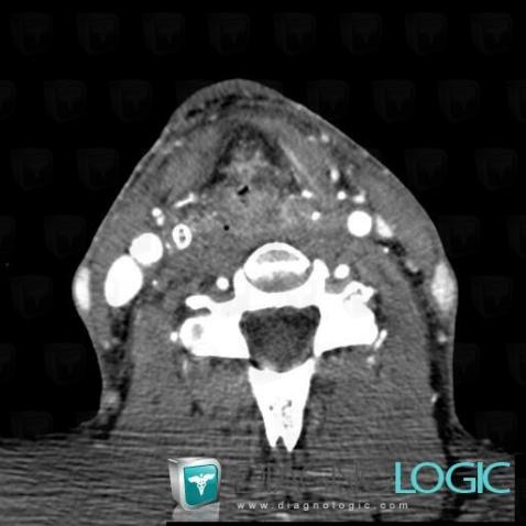 Postradiation edema, Pharyngolarynx, CT