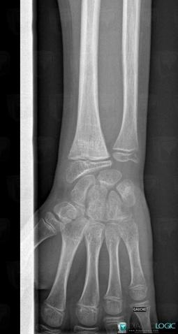 Posttraumatic, Radius - Distal part, X rays