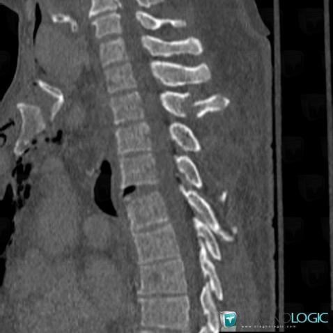 Posttraumatic, Vertebral body / Disk, CT