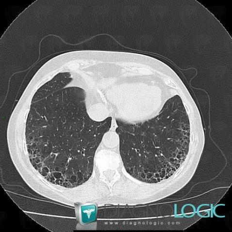 lésion poumon scanner – lésion pulmonaire scanner – Aep22