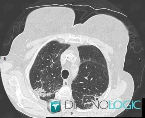 Poumon rhumatoïde, Parenchyme pulmonaire, Scanner