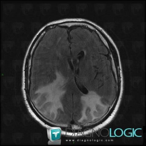 Radiology Case : Pres Syndrome (mri) - Diagnologic