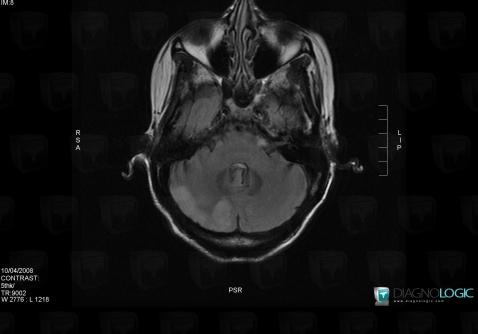 PRES syndrome, Hémisphère cérébelleux, Fosse postérieure, IRM