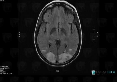 PRES syndrome, Hémisphères cérébraux, IRM