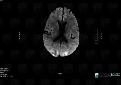PRES syndrome, Hémisphères cérébraux, IRM