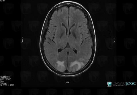 PRES syndrome, Région cortico sous corticale, IRM