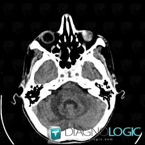 Progressive multifocal leukoencephalopathy, Brainstem, Cerebellar hemisphere, CT