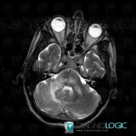 Progressive multifocal leukoencephalopathy, Brainstem, Cerebellar hemisphere, MRI