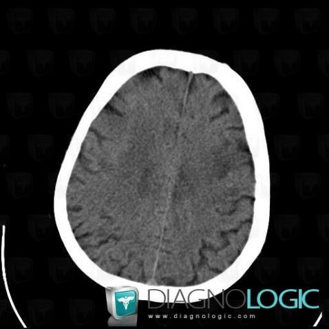 Progressive multifocal leukoencephalopathy, Cerebral hemispheres, CT