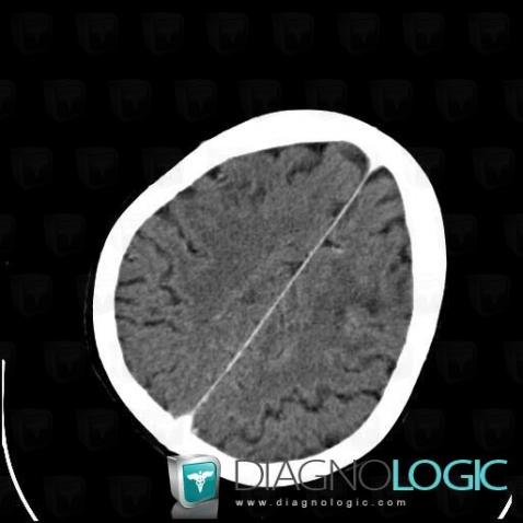 Progressive multifocal leukoencephalopathy, Cerebral hemispheres, CT