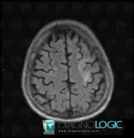 Progressive multifocal leukoencephalopathy, Cerebral hemispheres, MRI