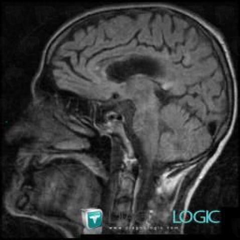 Progressive multifocal leukoencephalopathy, Corpus callosum, MRI