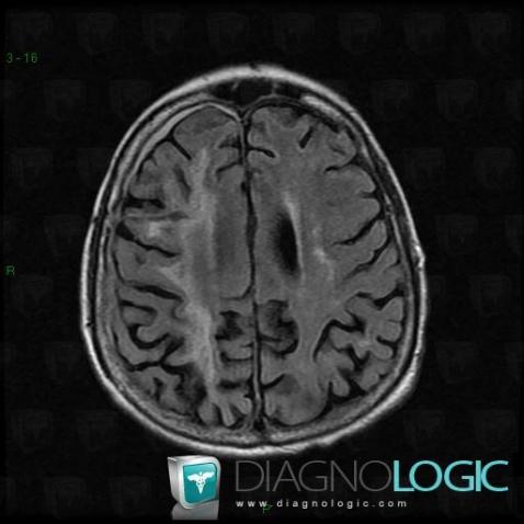 Progressive multifocal leukoencephalopathy, Cortico subcortical region, Cerebral hemispheres, MRI