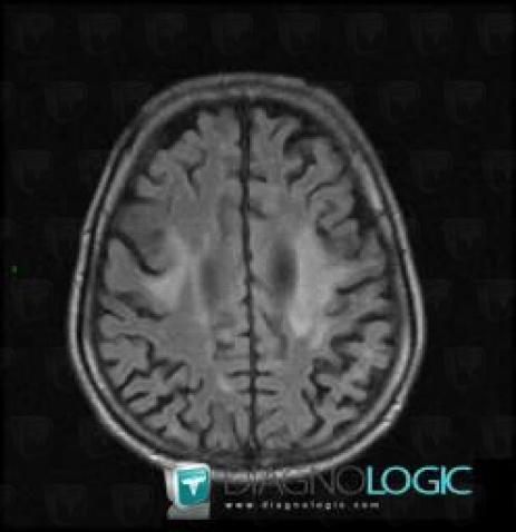 Progressive multifocal leukoencephalopathy, Cortico subcortical region, Cerebral hemispheres, MRI