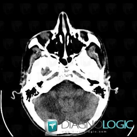 Progressive multifocal leukoencephalopathy, Posterior fossa, CT