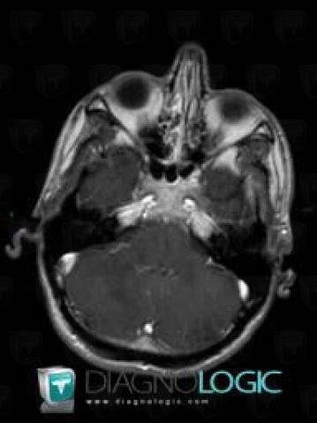 Progressive multifocal leukoencephalopathy, Posterior fossa, MRI