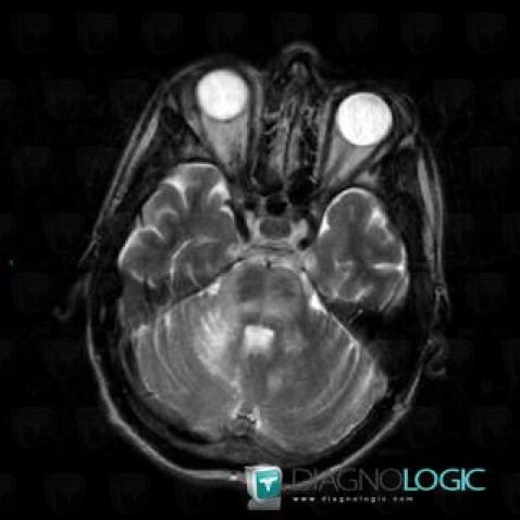 Progressive multifocal leukoencephalopathy, V4 and vermis, MRI