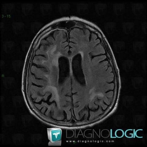 Progressive multifocal leukoencephalopathy, Ventricles / Periventricular region, MRI