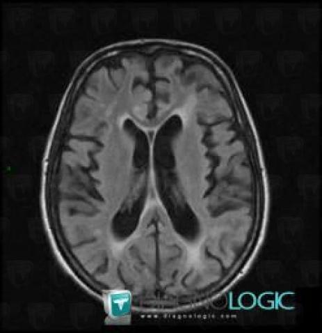 Progressive multifocal leukoencephalopathy, Ventricles / Periventricular region, MRI
