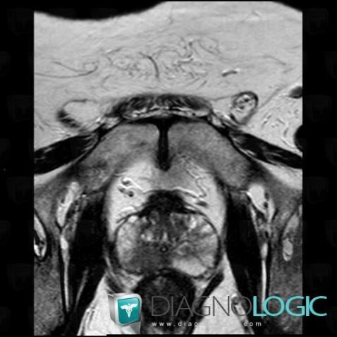 Prostate cancer, Prostate, MRI
