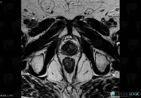 Prostate cancer, Prostate, MRI