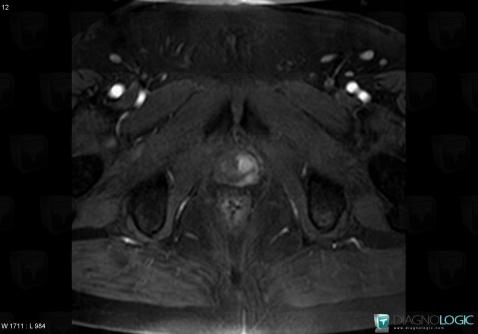 Prostate cancer, Prostate, MRI