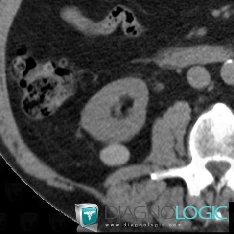 Proteinous cyst, Kidney, CT