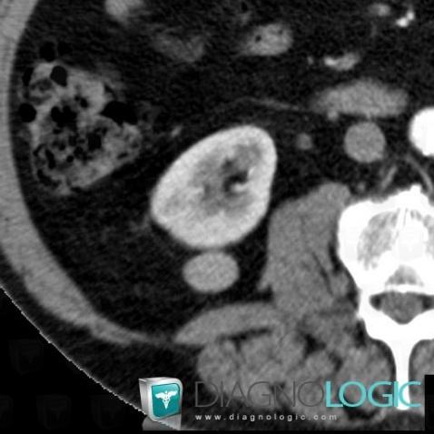 Proteinous cyst, Kidney, CT