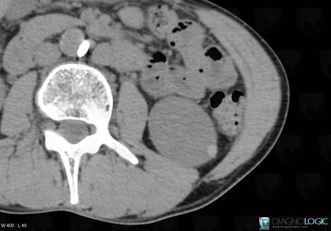 Proteinous cyst, Kidney, CT