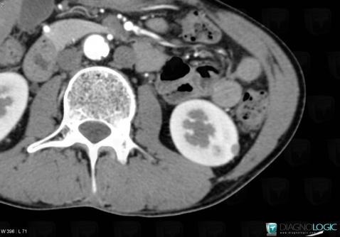 Radiology case : Proteinous cyst (CT) - Diagnologic