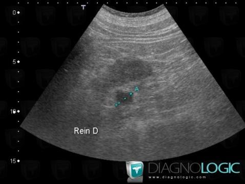 Proteinous cyst, Kidney, US