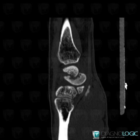 Pseudarthrosis , Scaphoid, CT