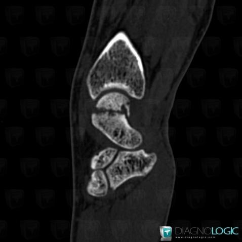 Pseudarthrosis , Scaphoid, CT