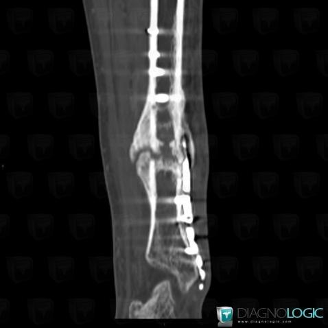 Pseudarthrosis , Tibia - Distal part, CT