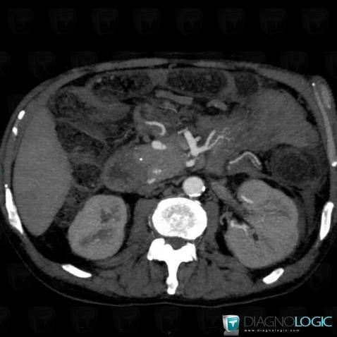 Pseudo-anévrisme, Pancréas, Autres artères - Abdomen, Scanner