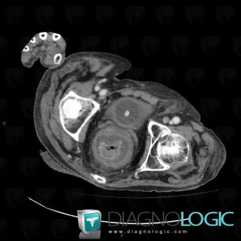 Pseudomembranous colitis, Rectum, CT