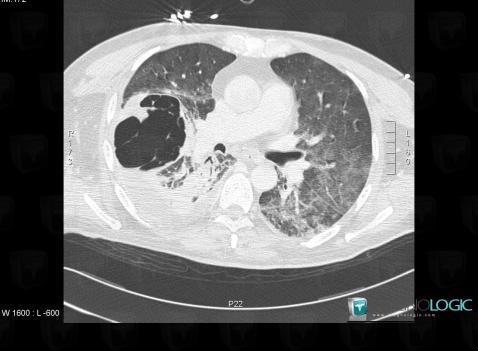 Pseudomonas pneumonia, Pulmonary parenchyma, CT