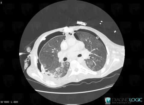 Pseudomonas pneumonia, Pulmonary parenchyma, CT