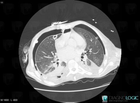 Pseudomonas pneumonia, Pulmonary parenchyma, CT