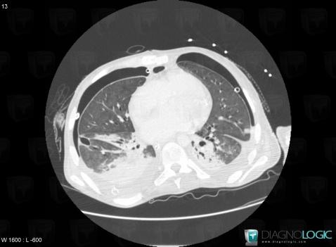 Pseudomonas pneumonia, Pulmonary parenchyma, CT