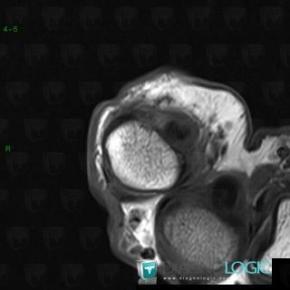 Pulley lesion /  Hand, Other soft tissues/nerves - Hand, MRI