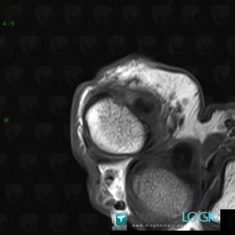 Pulley lesion /  Hand, Other soft tissues/nerves - Hand, MRI