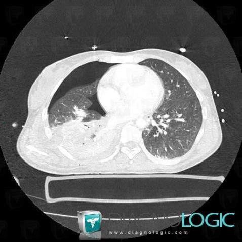Pulmonary contusion, Pulmonary parenchyma, CT