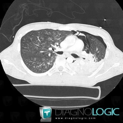 Pulmonary contusion, Pulmonary parenchyma, CT