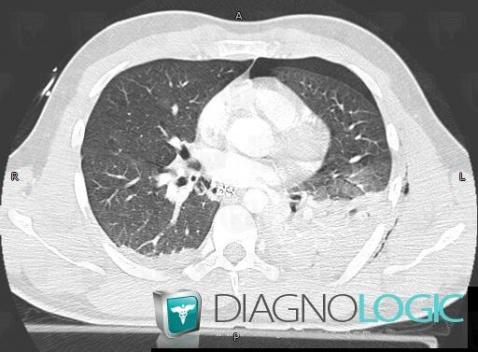 Pulmonary contusion, Pulmonary parenchyma, CT